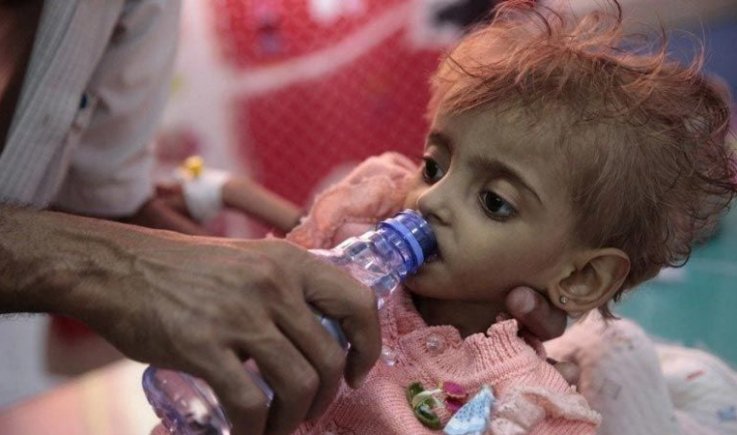 "سي إن إن" تعترف: الحصار السعودي أدى إلى تفاقم المجاعة في اليمن