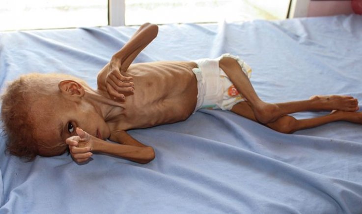 "الجحيم على الأرض".. اليمن يُواجه أكبر مجاعة في التاريخ الحديث