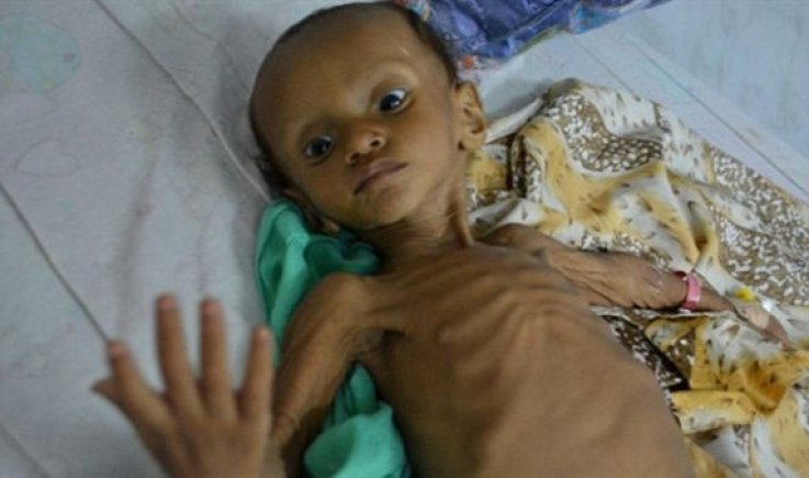 وزارة الصحة تكشف احصائيات مخيفة لضحيا الأوبئة في اليمن خلال عام 2022