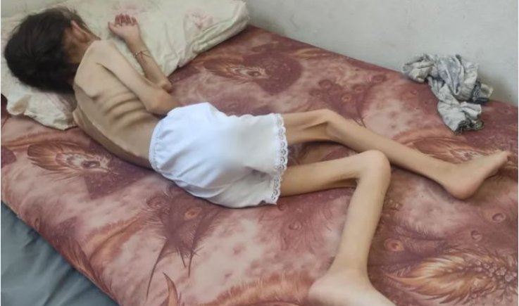 في نداء عاجل لها .. الأمم المتحدة : أكثر من 100 طفل قضوا نحبهم جوعا في غزة